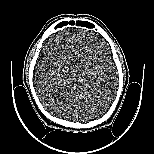 Corte axial CT