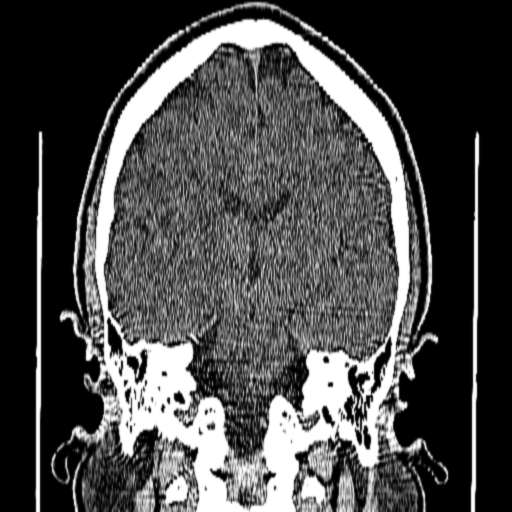 Corte coronal CT