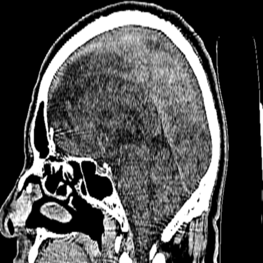 Corte sagital CT